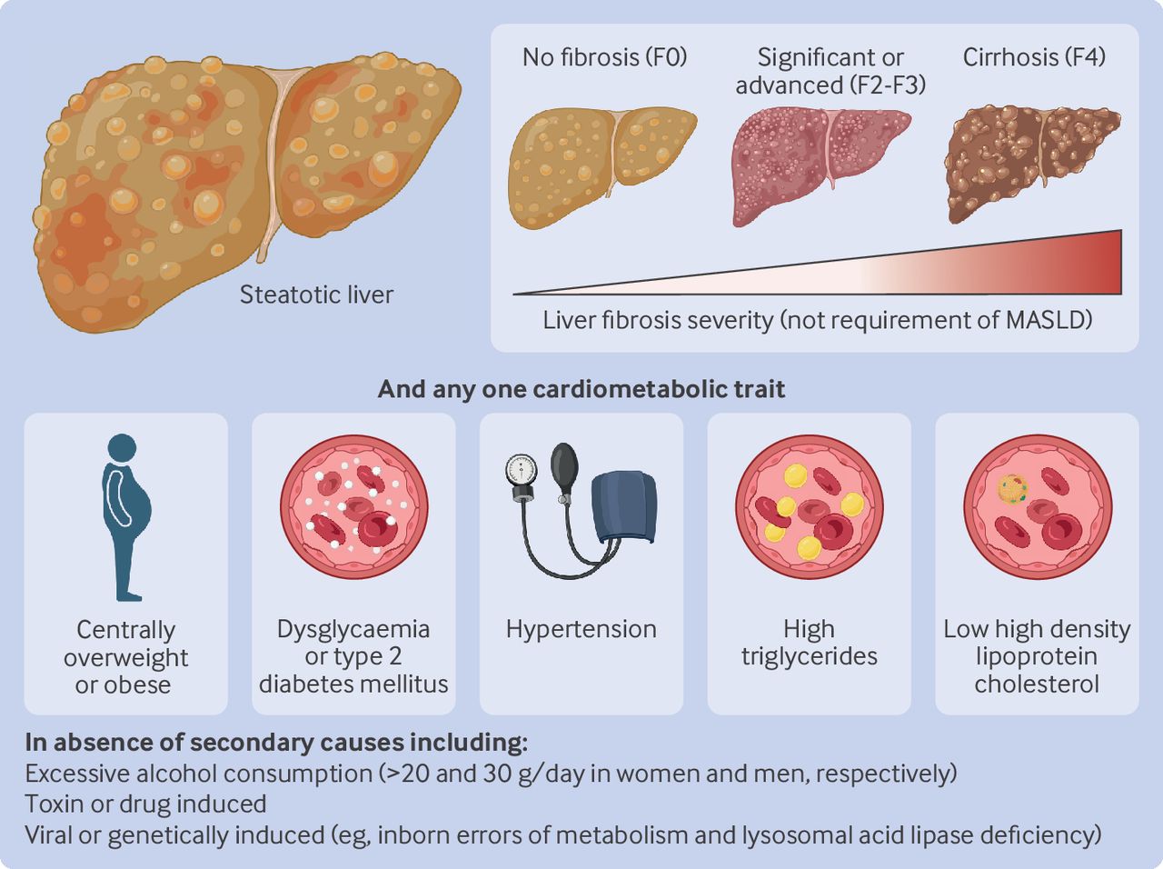 Metabolic dysfunction associated steatotic liver disease: mechanisms ...